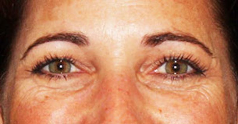 BOTOX Before & After Gallery - Patient 3891487 - Image 3