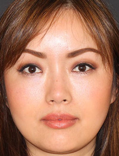 BOTOX Before & After Gallery - Patient 3891488 - Image 2
