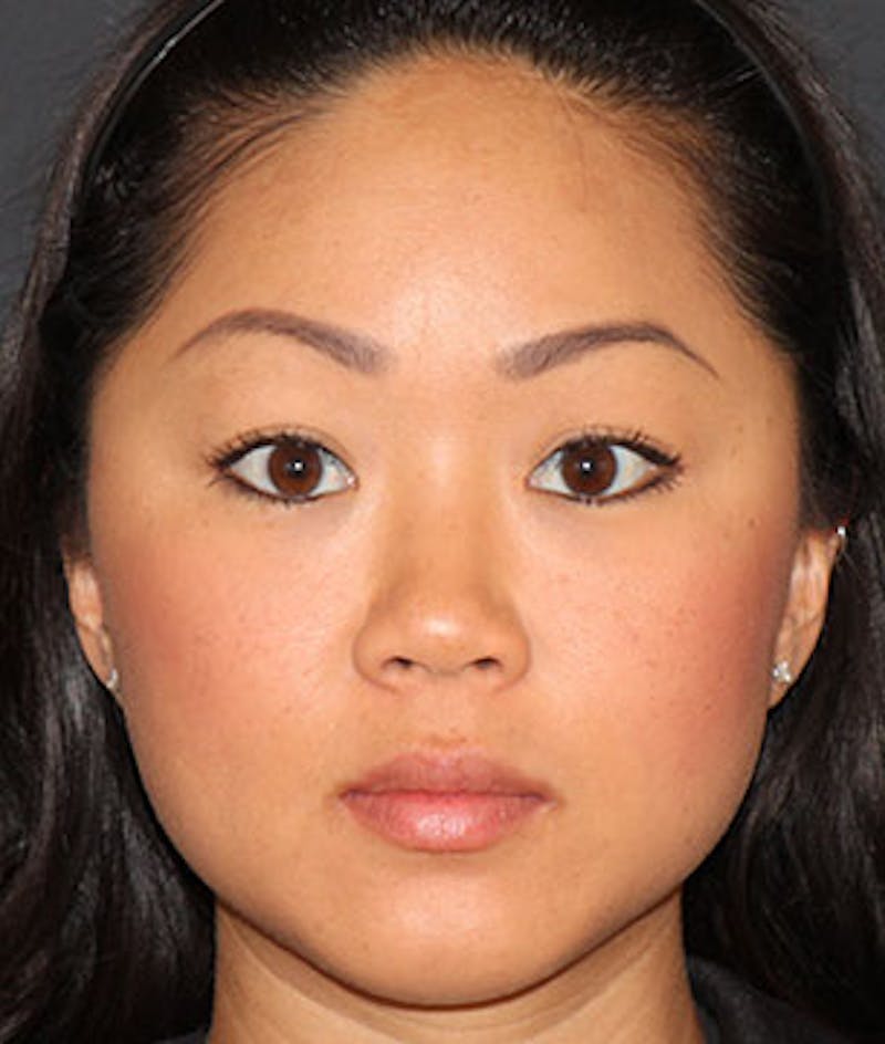 BOTOX Before & After Gallery - Patient 3891491 - Image 1