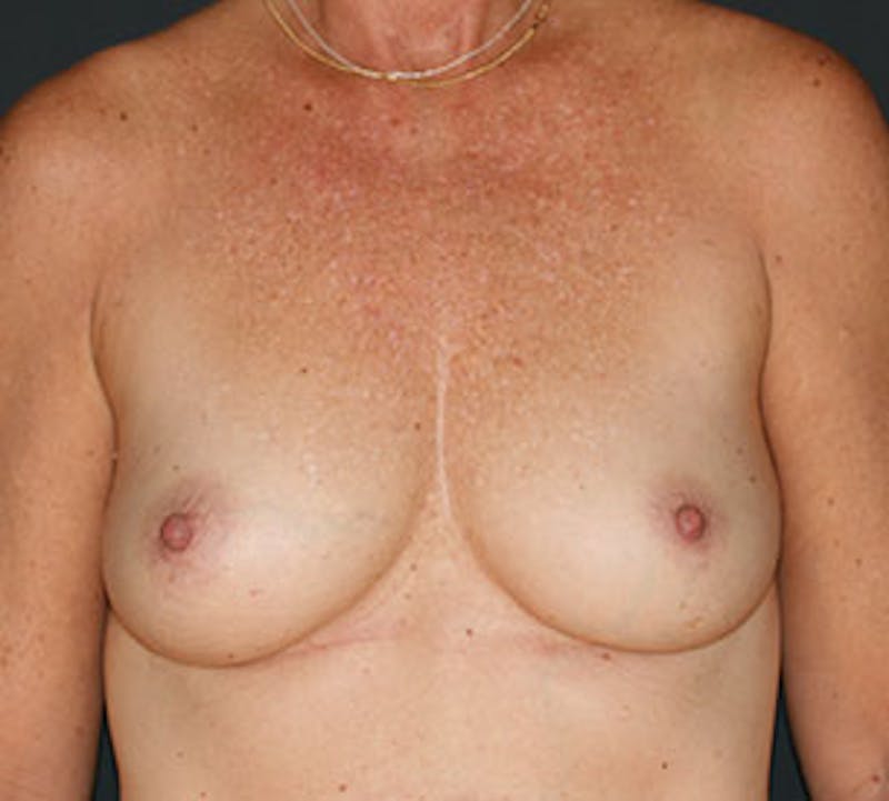 Breast Reconstruction Before & After Gallery - Patient 3891494 - Image 1