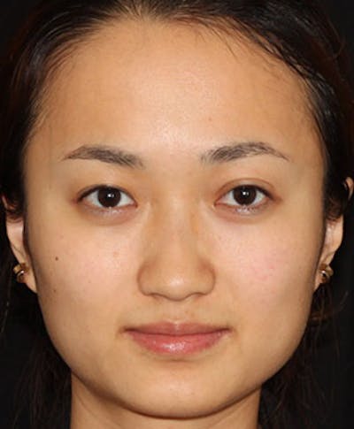 BOTOX Before & After Gallery - Patient 3891492 - Image 2