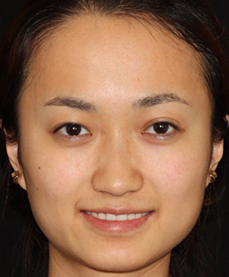 BOTOX Before & After Gallery - Patient 3891492 - Image 4