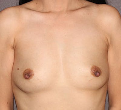 Breast Augmentation Before & After Gallery - Patient 132688411 - Image 1