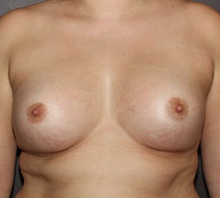 Breast Augmentation Before & After Gallery - Patient 132688903 - Image 2