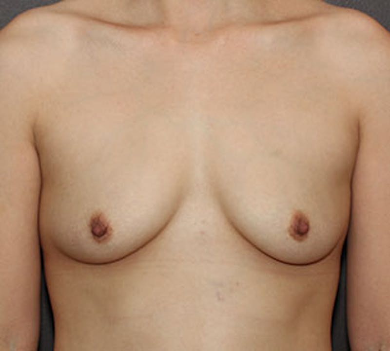 Breast Augmentation Before & After Gallery - Patient 132694676 - Image 1