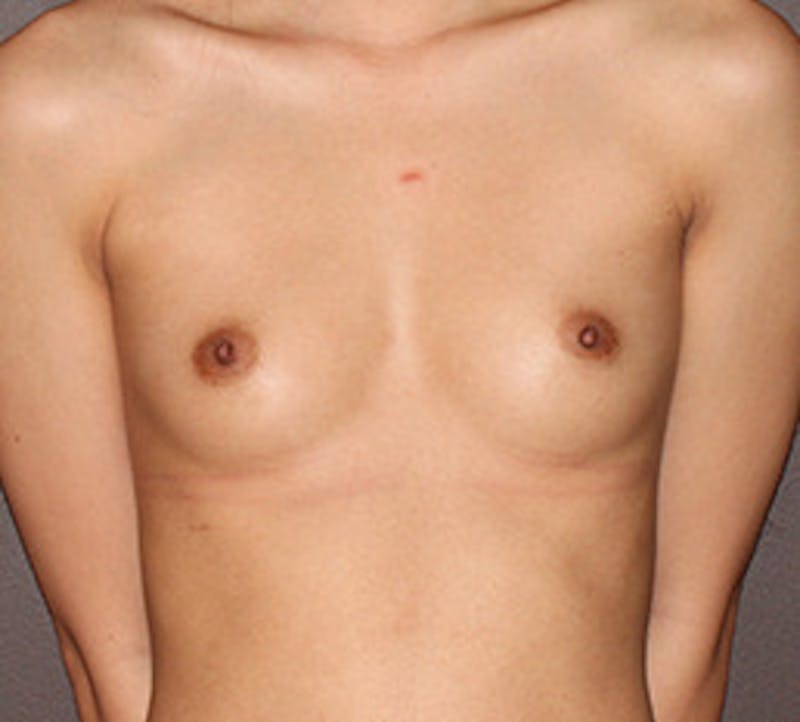 Breast Augmentation Before & After Gallery - Patient 132697576 - Image 1