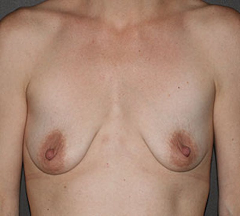 Breast Augmentation Before & After Gallery - Patient 132700448 - Image 1