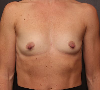 Breast Augmentation Before & After Gallery - Patient 415311 - Image 1