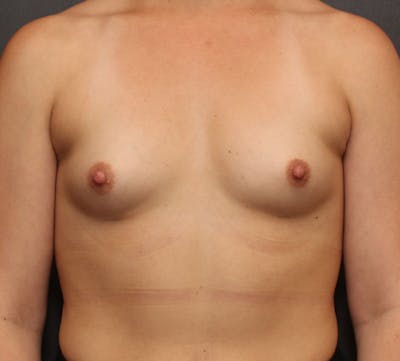 Breast Augmentation Before & After Gallery - Patient 164044 - Image 1