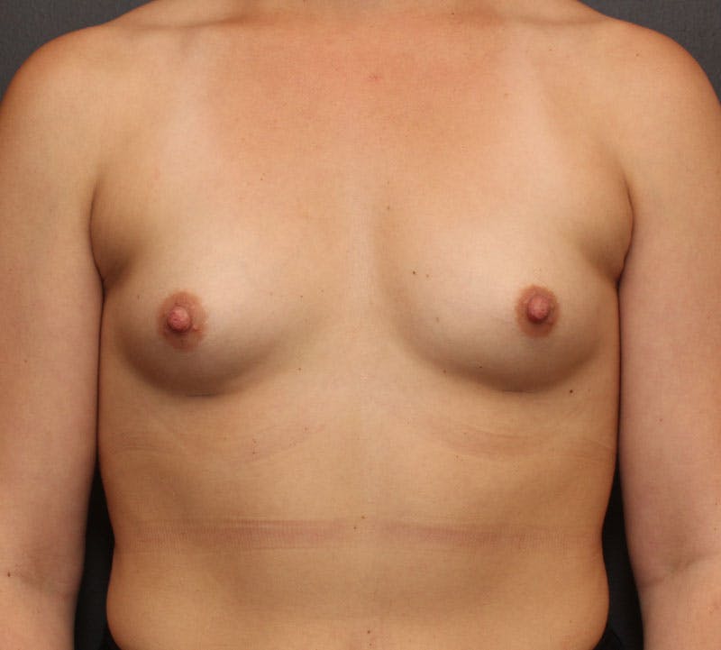 Breast Augmentation Before & After Gallery - Patient 164044 - Image 1