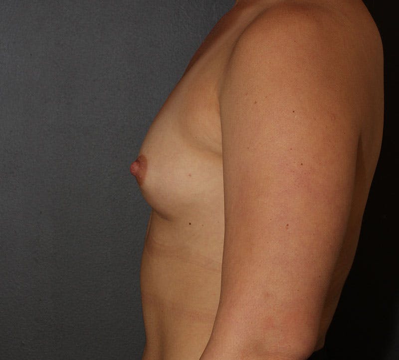 Breast Augmentation Before & After Gallery - Patient 164044 - Image 7