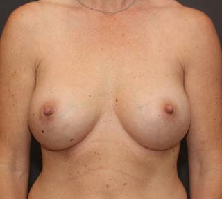 Breast Augmentation Before & After Gallery - Patient 734411 - Image 2