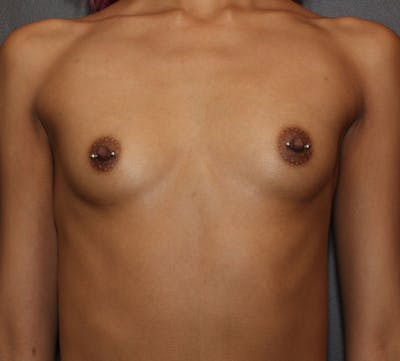Breast Augmentation Before & After Gallery - Patient 246406 - Image 1