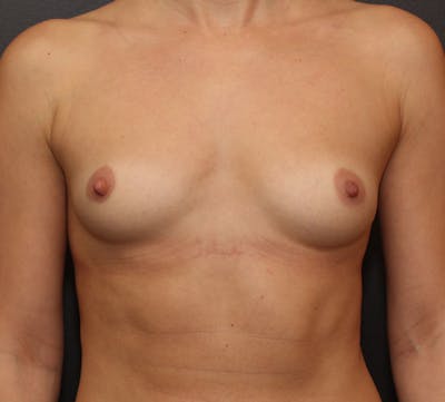 Breast Augmentation Before & After Gallery - Patient 246183 - Image 1