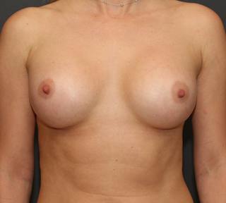 Breast Augmentation Before & After Gallery - Patient 246183 - Image 2