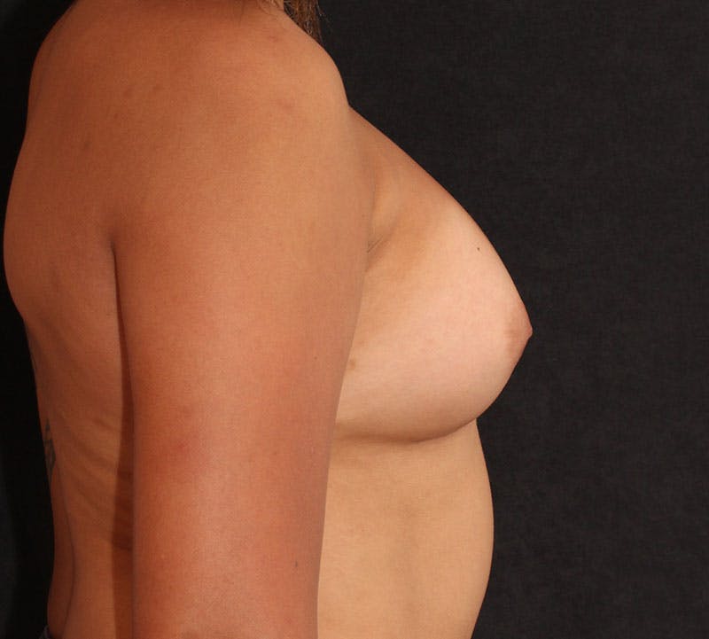 Breast Augmentation Before & After Gallery - Patient 382934 - Image 6