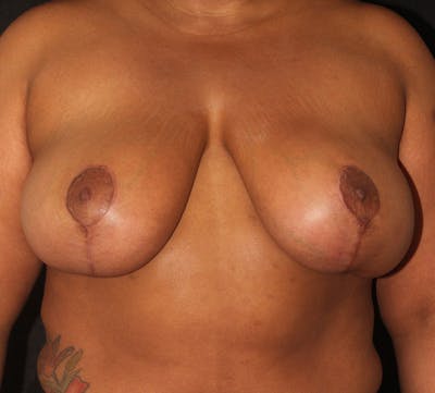Breast Reduction and Mastopexy (Lift) Before & After Gallery - Patient 113370 - Image 2
