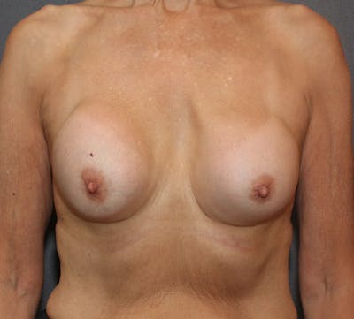 Breast Revision Before & After Gallery - Patient 720432 - Image 1