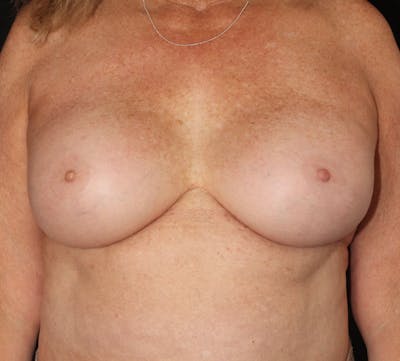 Breast Revision Before & After Gallery - Patient 138653 - Image 2