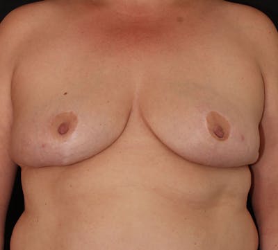 Nipple Inversion Before & After Gallery - Patient 956501 - Image 2