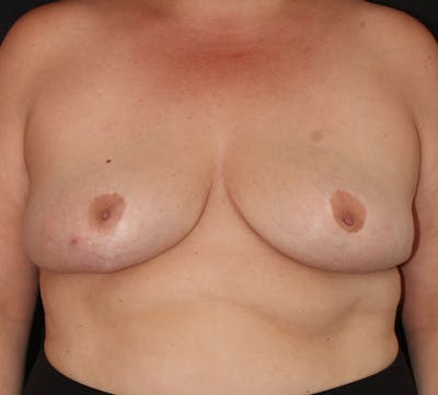 Nipple Inversion Before & After Gallery - Patient 956501 - Image 1