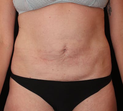Abdominoplasty (Tummy Tuck) Before & After Gallery - Patient 374169 - Image 1