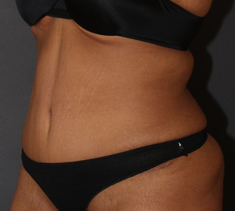 Abdominoplasty (Tummy Tuck) Before & After Gallery - Patient 234901 - Image 6