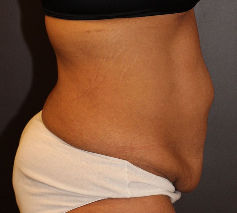Abdominoplasty (Tummy Tuck) Before & After Gallery - Patient 234901 - Image 7