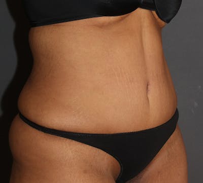 Abdominoplasty (Tummy Tuck) Before & After Gallery - Patient 234901 - Image 2