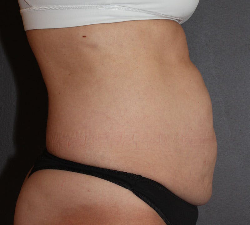 Abdominoplasty (Tummy Tuck) Before & After Gallery - Patient 376581 - Image 5