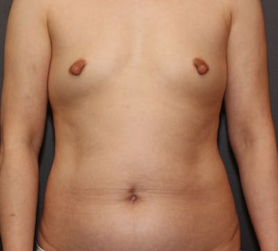 Liposuction Before & After Gallery - Patient 894312 - Image 1