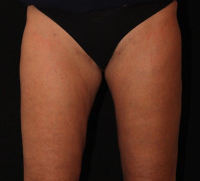 Liposuction Before & After Gallery - Patient 340044 - Image 2