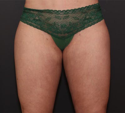 Liposuction Before & After Gallery - Patient 258852 - Image 2