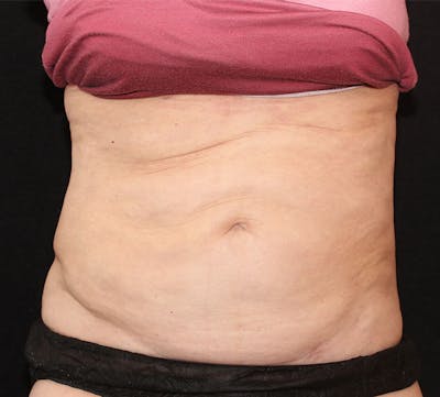 Liposuction Before & After Gallery - Patient 122370 - Image 2