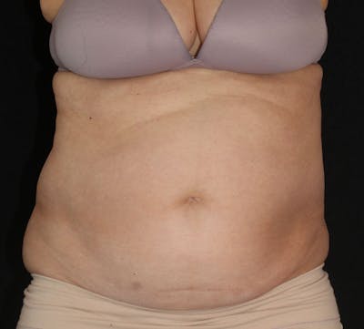 Liposuction Before & After Gallery - Patient 122370 - Image 1