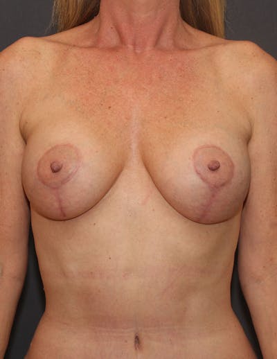 Mommy Makeover Before & After Gallery - Patient 264918 - Image 2
