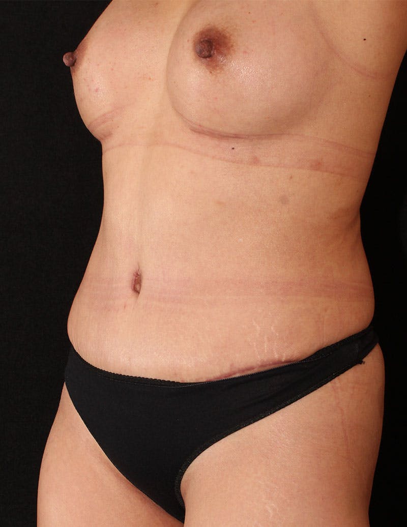 Mommy Makeover Before & After Gallery - Patient 112241 - Image 10