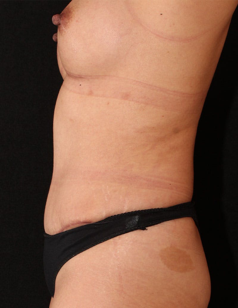 Mommy Makeover Before & After Gallery - Patient 112241 - Image 8