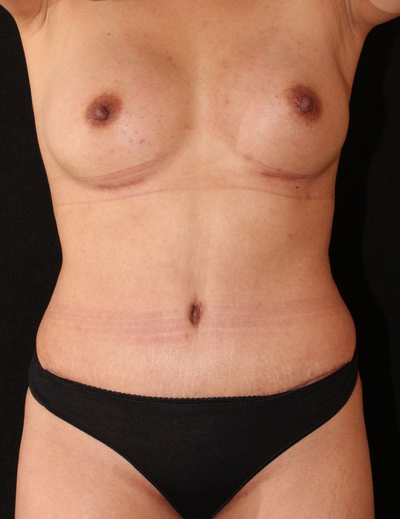 Mommy Makeover Before & After Gallery - Patient 112241 - Image 2
