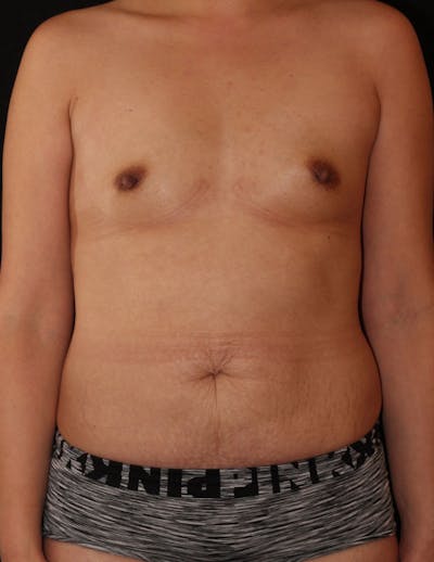 Mommy Makeover Before & After Gallery - Patient 112241 - Image 1