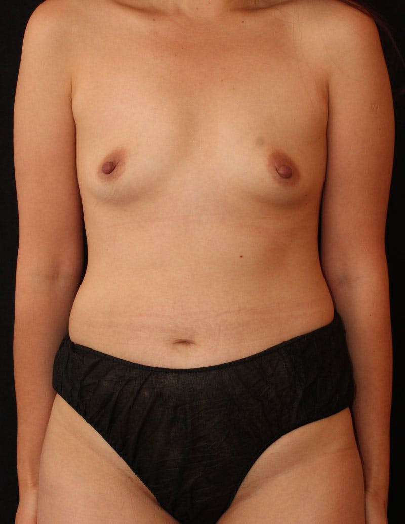 Mommy Makeover Before & After Gallery - Patient 186639 - Image 1