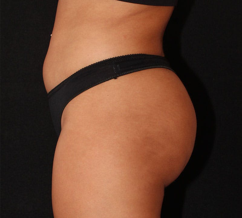 Brazilian Butt Lift Before & After Gallery - Patient 941046 - Image 14