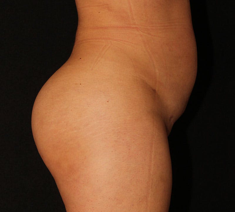 Brazilian Butt Lift Before & After Gallery - Patient 292585 - Image 6