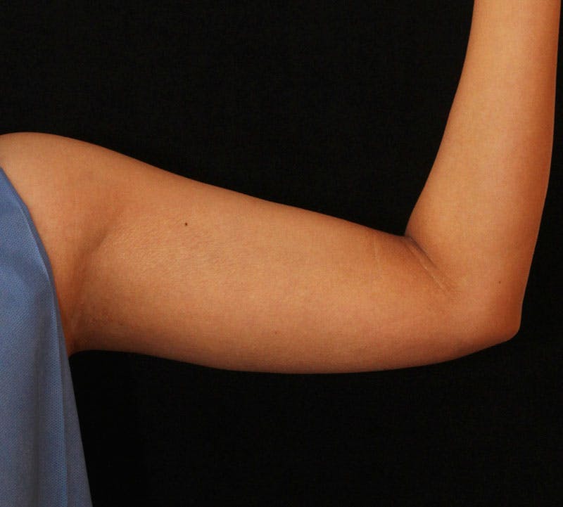 Bodytite Before & After Gallery - Patient 170200 - Image 2