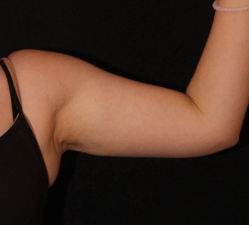 Bodytite Before & After Gallery - Patient 259745 - Image 6