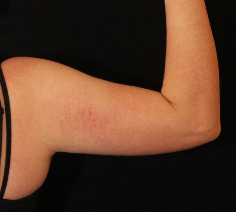 Bodytite Before & After Gallery - Patient 259745 - Image 4