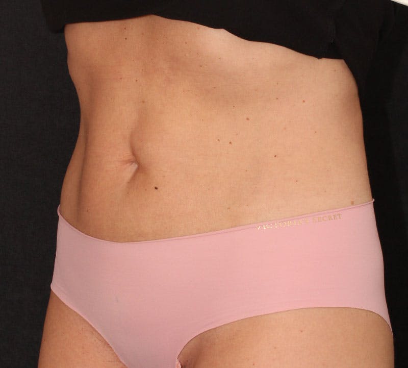 Bodytite Before & After Gallery - Patient 243233 - Image 10
