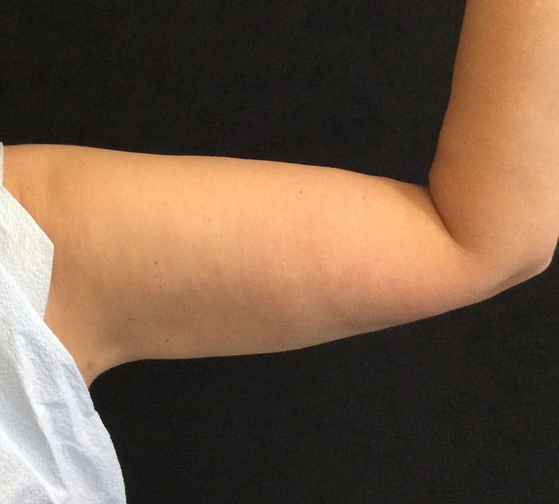 Bodytite Before & After Gallery - Patient 852725 - Image 2
