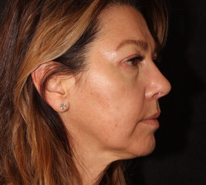 Browlift/Upper Blepharoplasty Before & After Gallery - Patient 242240 - Image 4