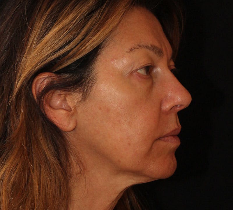 Browlift/Upper Blepharoplasty Before & After Gallery - Patient 242240 - Image 3